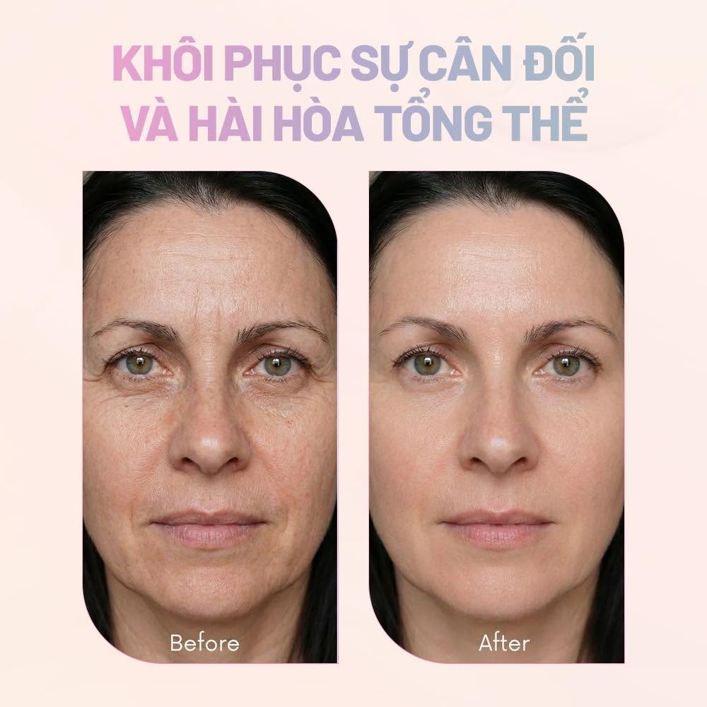 Filler HA Neotiva Hàn Quốc Soft+, Deep+, Volume+, Implant+ – Chất Làm Đầy Hyaluronic Acid Chính Hãng