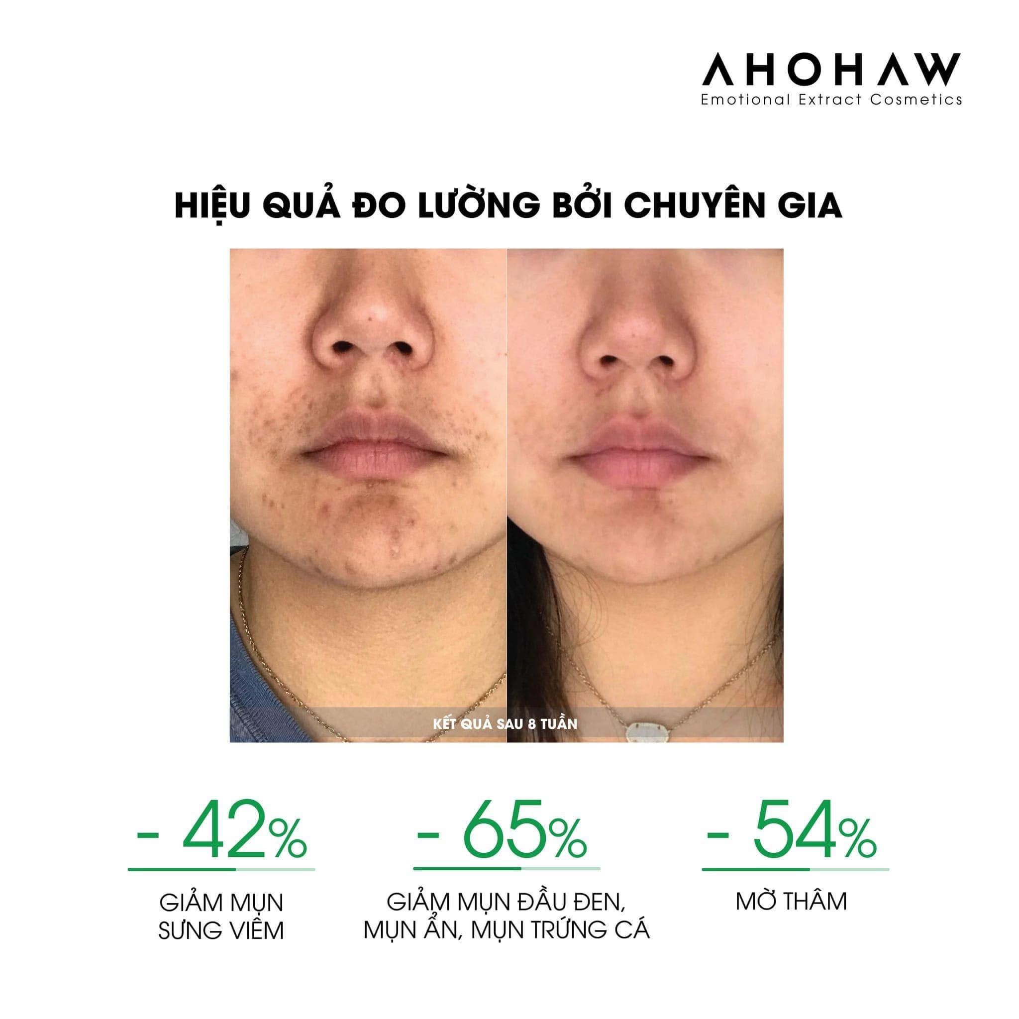 Kem dưỡng ẩm giảm mụn trứng cá Ahohwa Acless Solution Control Clear Cream