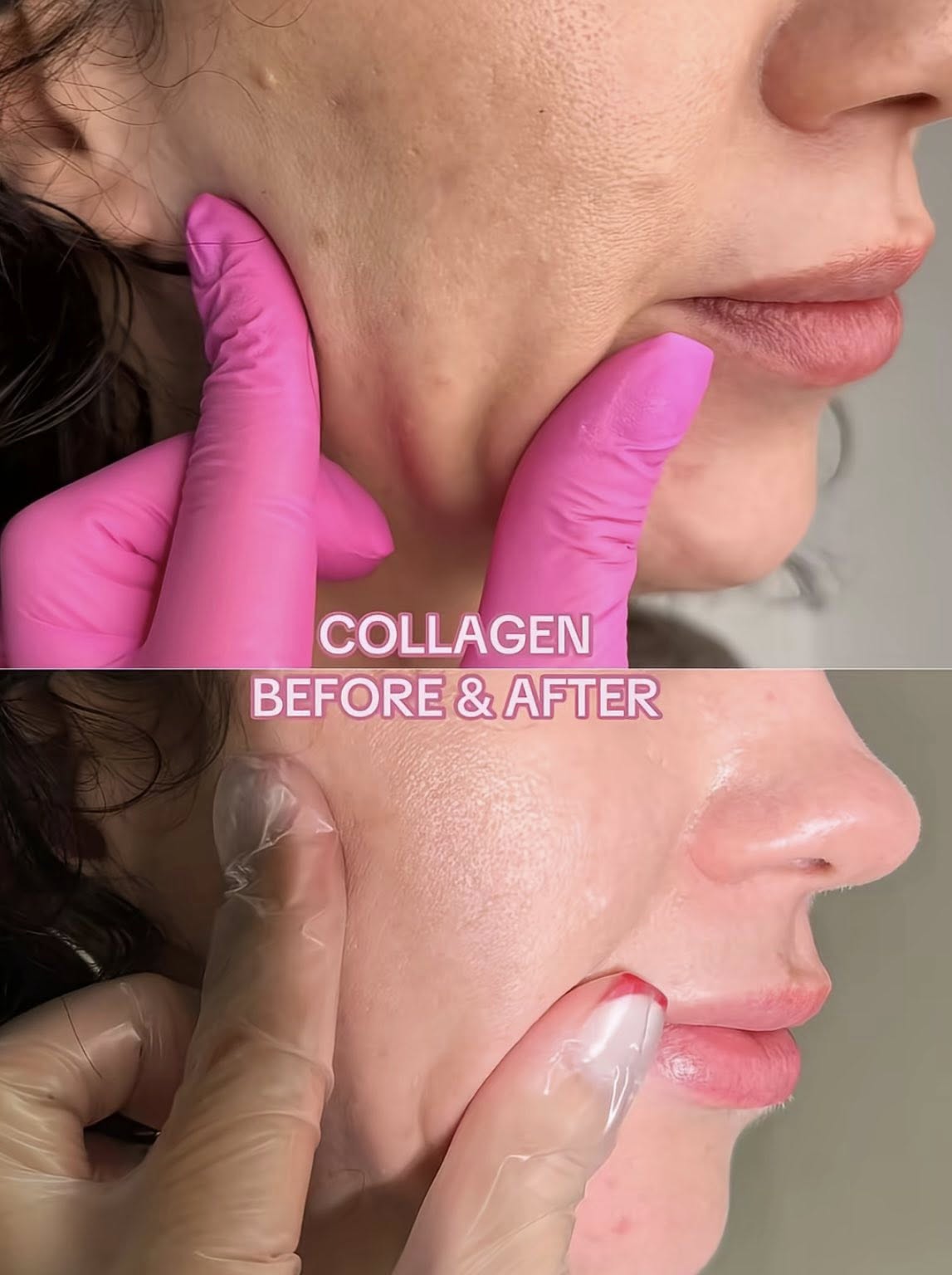 LINERASE COLLAGEN – PHỤC HỒI & TÁI TẠO DA THẾ HỆ MỚI BẰNG COLLAGEN SINH HỌC