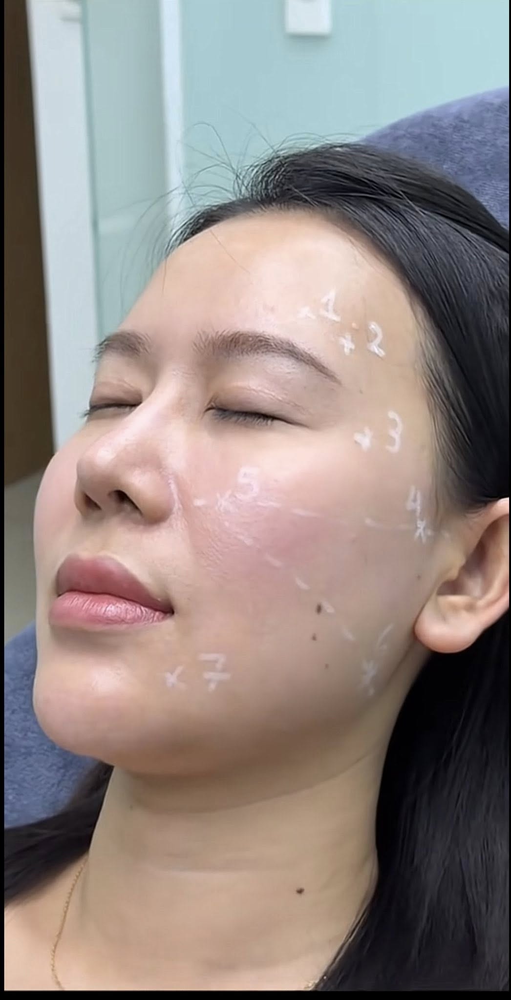 LINERASE COLLAGEN – PHỤC HỒI & TÁI TẠO DA THẾ HỆ MỚI BẰNG COLLAGEN SINH HỌC
