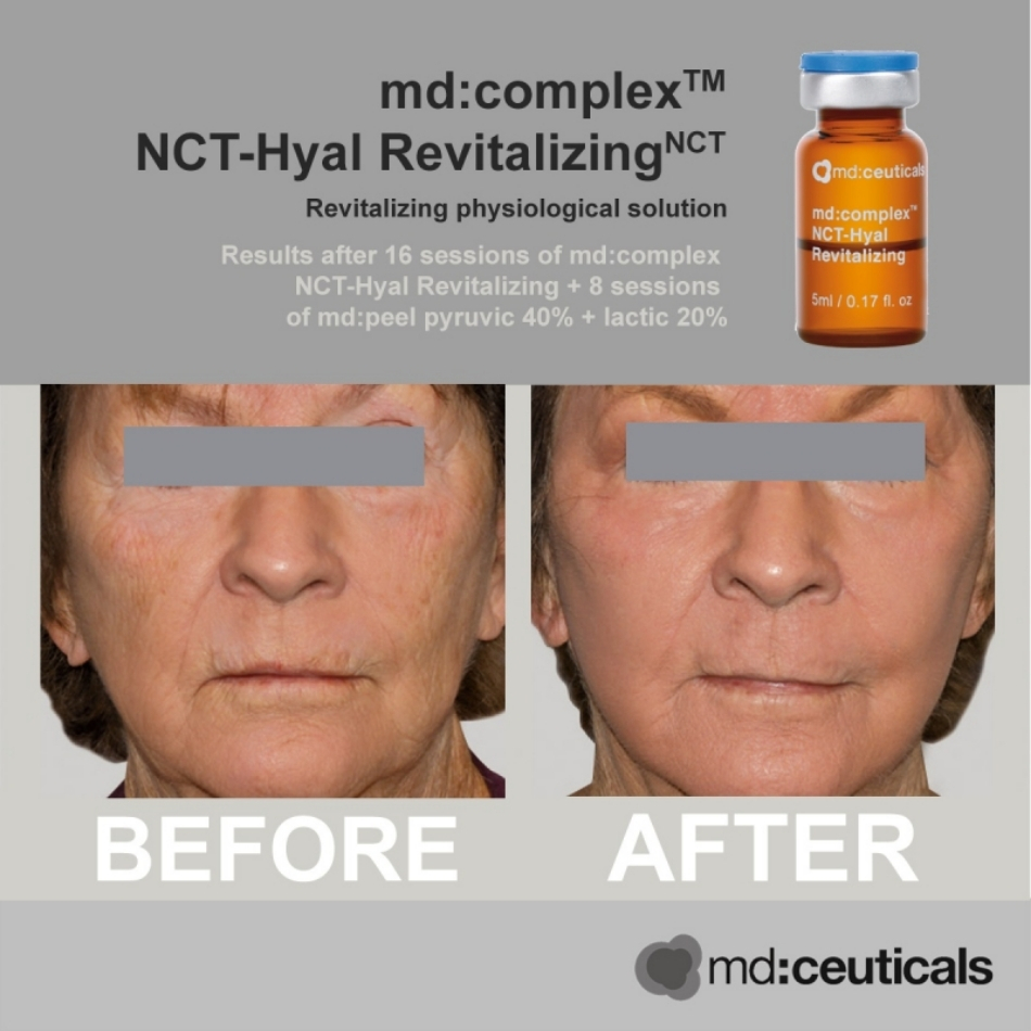 Meso chống oxy hóa căng bóng da Md:Ceuticals Md:Complex Nct-Hyal Revitalizing Cx