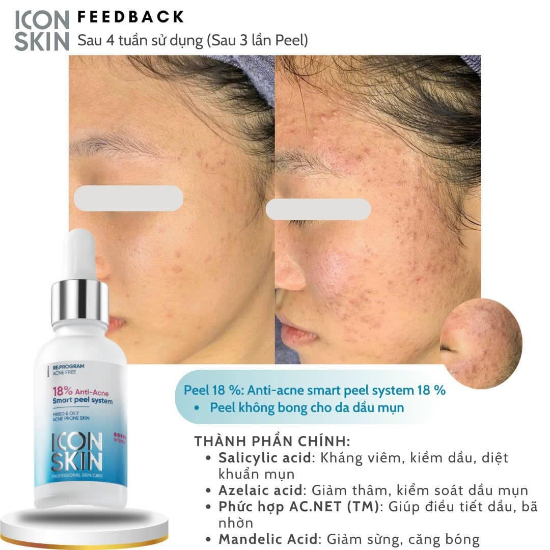 Peel da không bong cho da dầu, da hỗn hợp Icon Skin 18% Anti-Acne Peel System