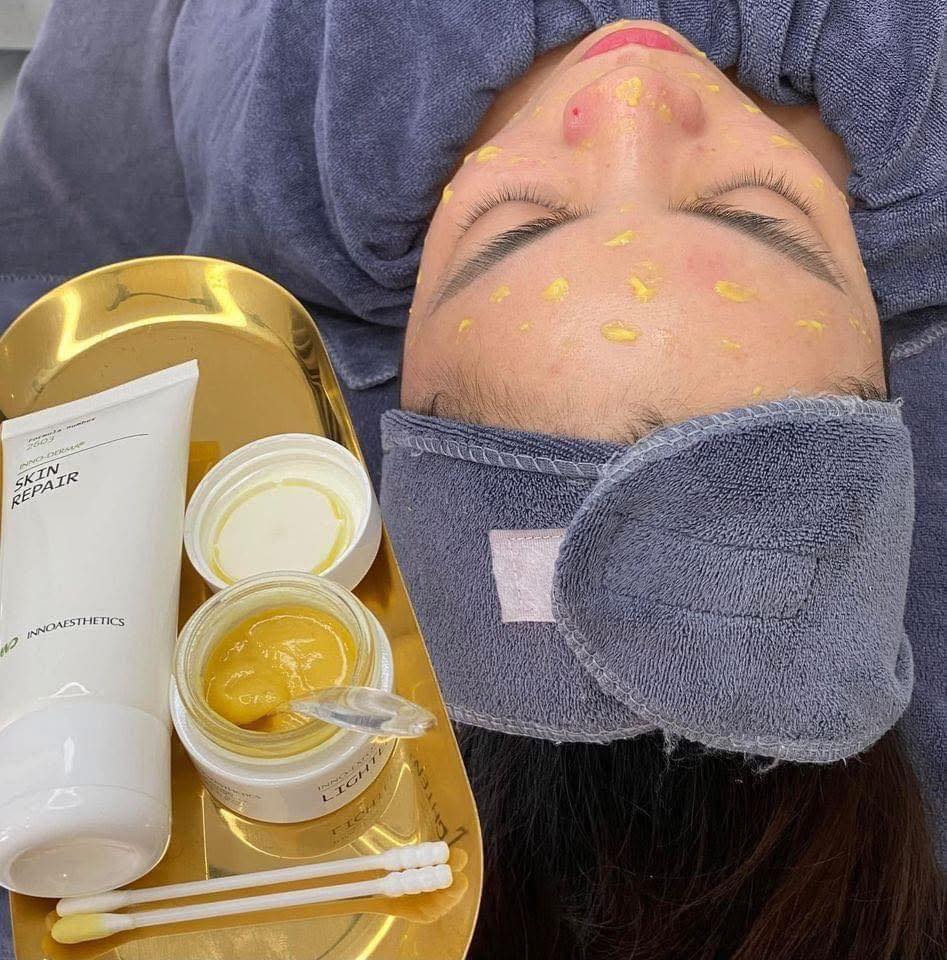 Peel trị mụn ẩn, đầu đen trẻ hóa da Lightening innoaesthetics