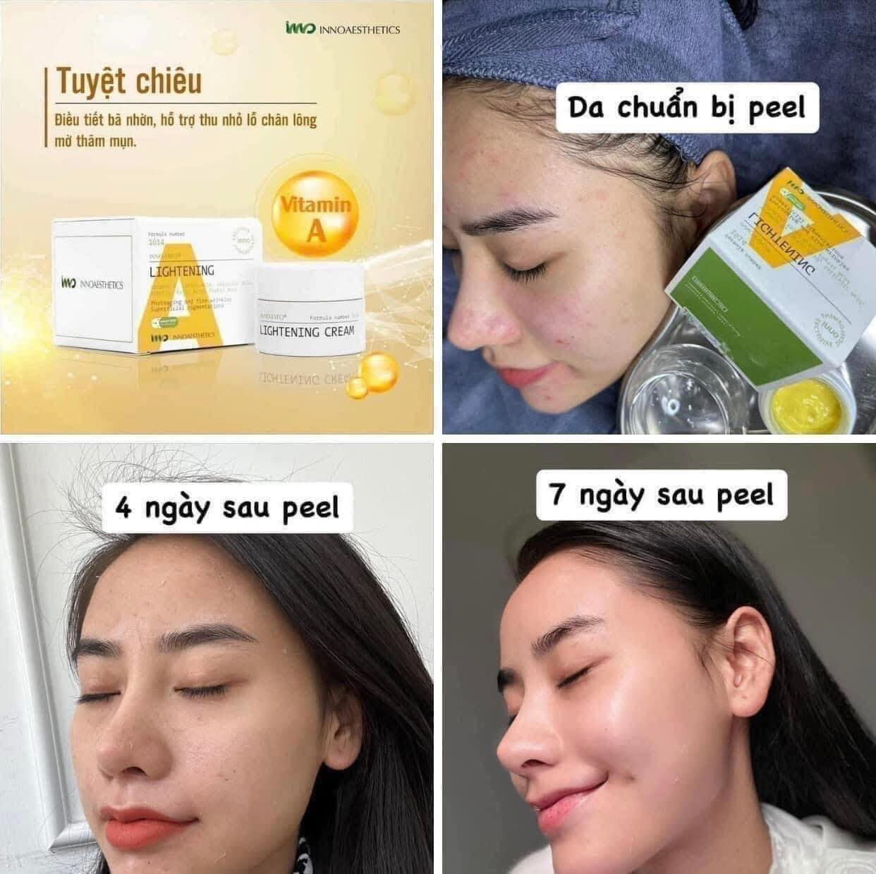 Peel trị mụn ẩn, đầu đen trẻ hóa da Lightening innoaesthetics