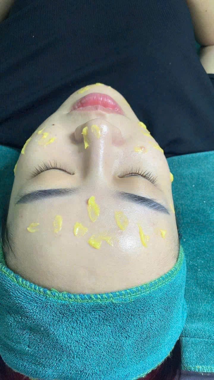 Peel trị mụn ẩn, đầu đen trẻ hóa da Lightening innoaesthetics