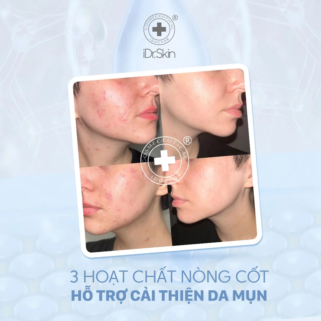 Sữa Rửa Mặt Làm Sạch Sâu Cho Da Dầu Mụn iDr.Skin Facial Cleansing Gel 120g