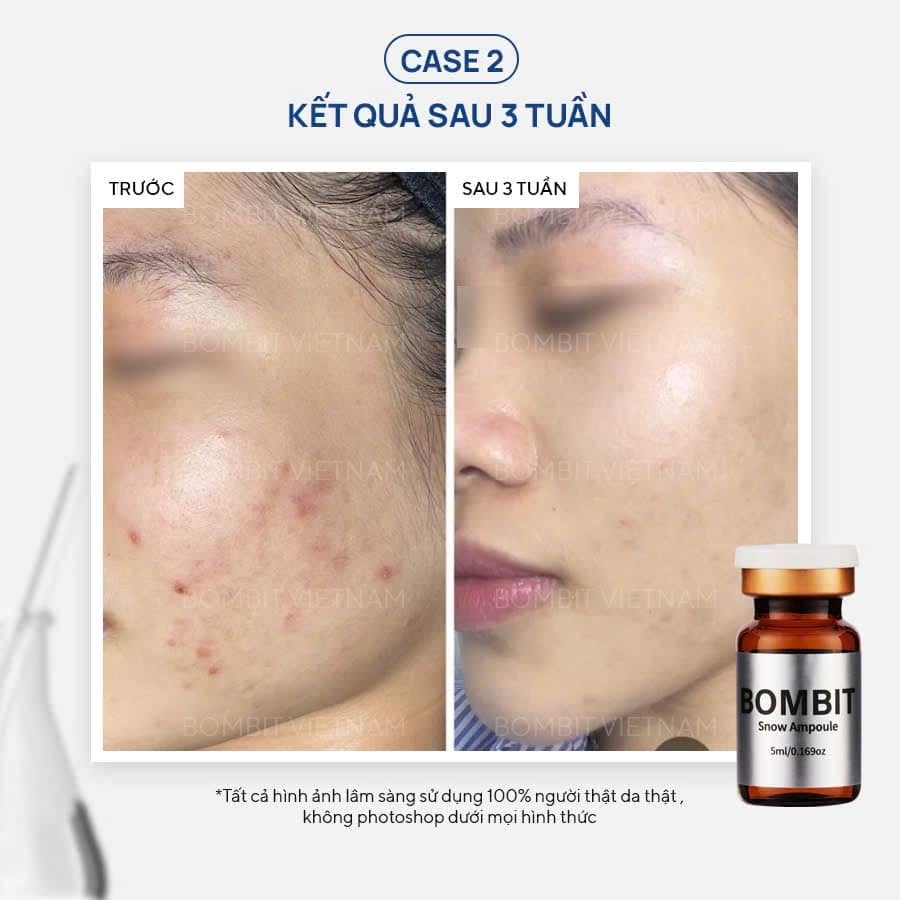 Tinh Chất Hỗ Trợ Điều Trị Nám, Sạm Và Làm Sáng Da BOMBIT Snow Meso