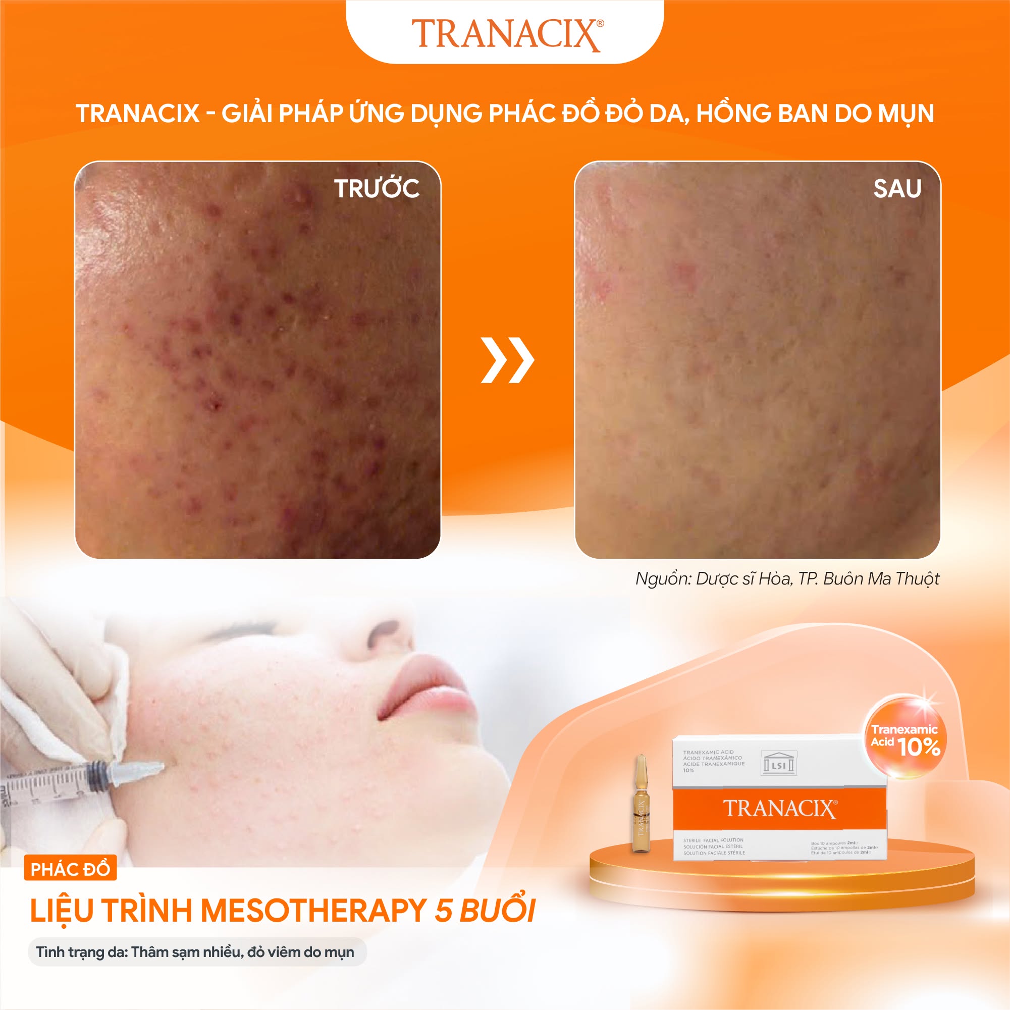 Tinh Chất TRANACIX 10% TRANACIX® Sterile Facial Solution - Hỗ Trợ Làm Mờ Nám Và Sắc Tố Chuyên Sâu Lẻ 1 Ống