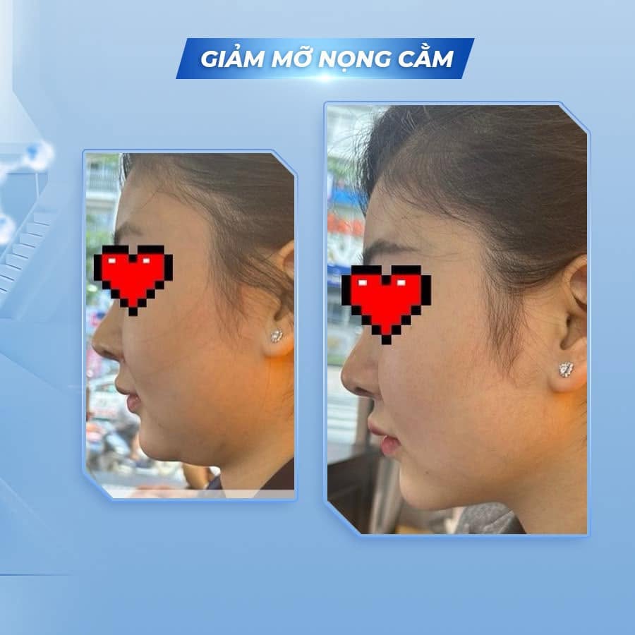 Tinh Chất Thon Gọn Mặt, Hỗ Trợ Giảm Mỡ Má Và Nọng Cằm BOMBIT Slim Face