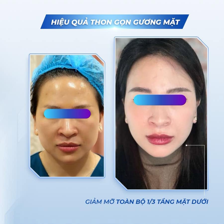 Tinh Chất Thon Gọn Mặt, Hỗ Trợ Giảm Mỡ Má Và Nọng Cằm BOMBIT Slim Face