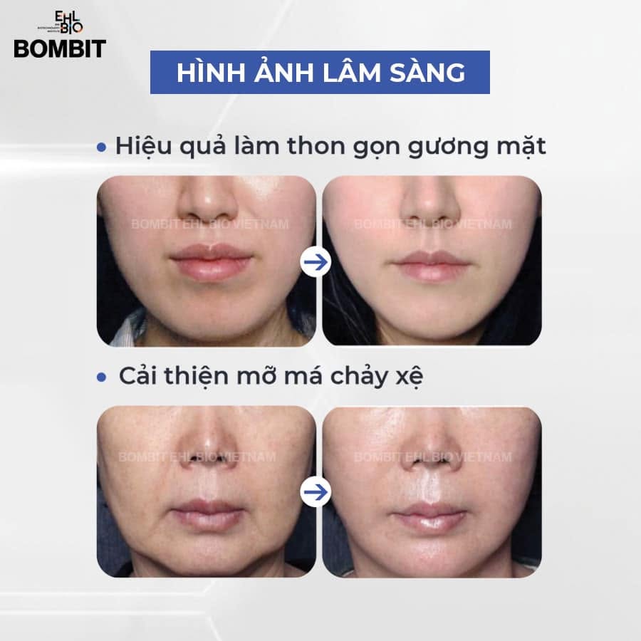 Tinh Chất Thon Gọn Mặt, Hỗ Trợ Giảm Mỡ Má Và Nọng Cằm BOMBIT Slim Face