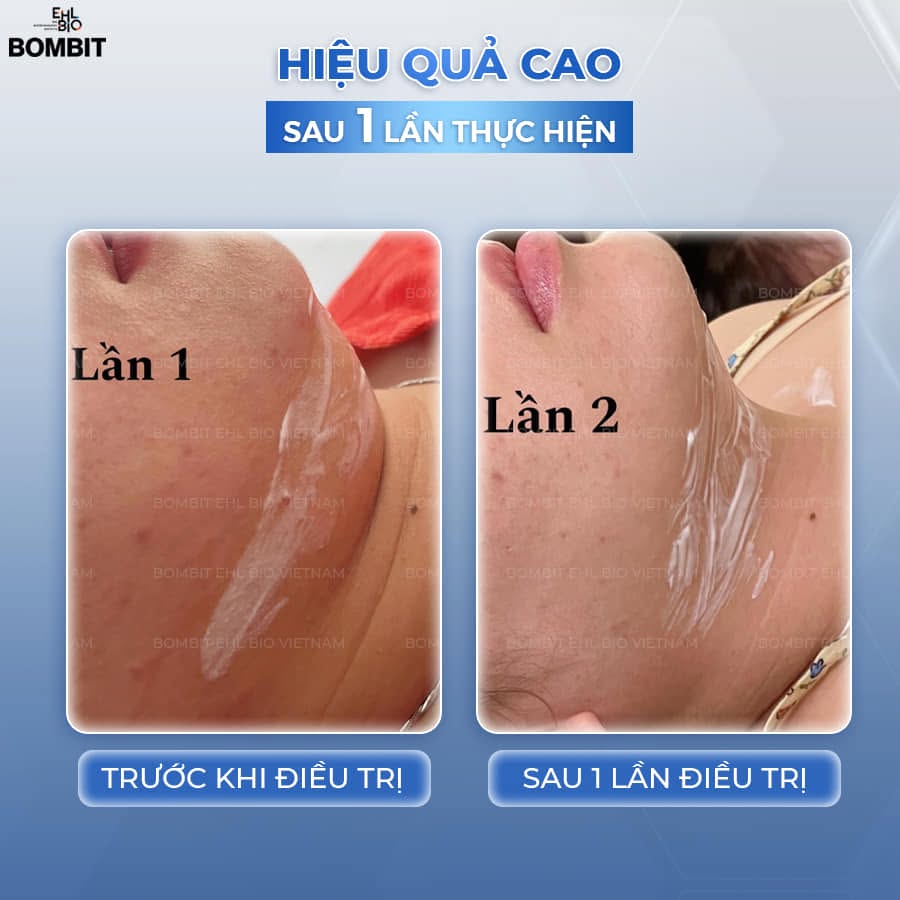 Tinh Chất Thon Gọn Mặt, Hỗ Trợ Giảm Mỡ Má Và Nọng Cằm BOMBIT Slim Face