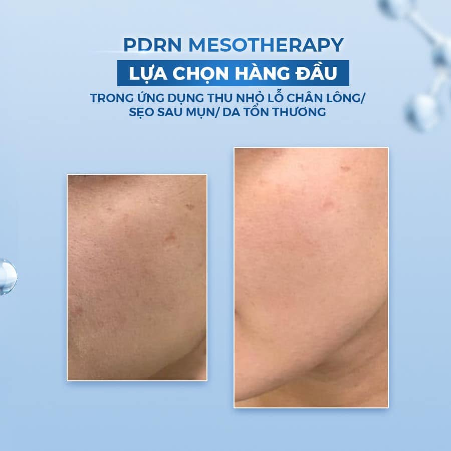 Tinh Chất Trẻ Hóa Da Từ Cá Hồi, Phục Hồi Và Căng Mịn Da BOMBIT PDRN Meso