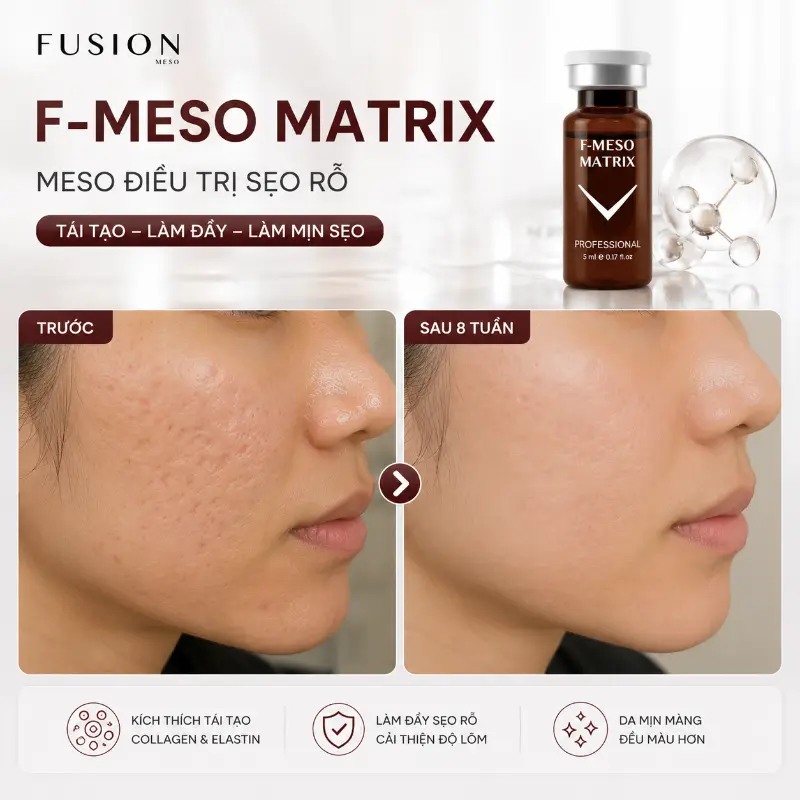 Tinh Chất Hỗ Trợ Cải Thiện Sẹo Lõm, Sẹo Rỗ Fusion F-Meso Matrix 5ml Chính Hãng