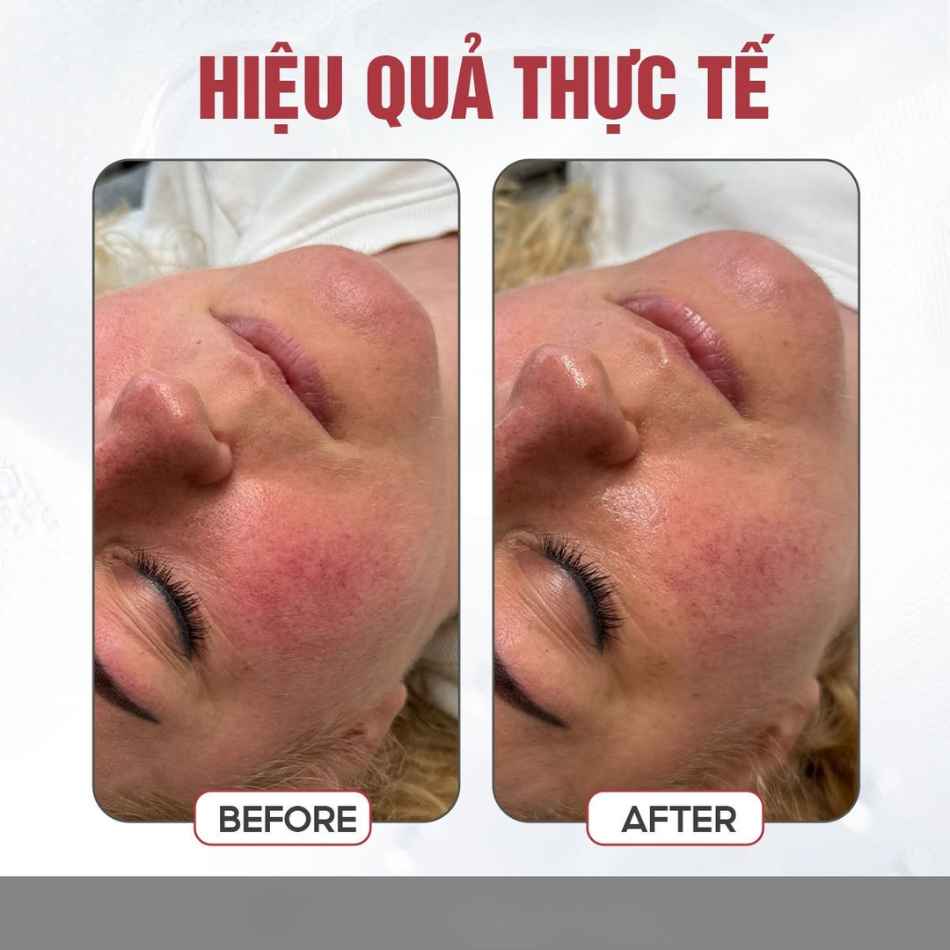 Tinh chất meso phục hồi da nhạy cảm, mỏng yếu Innoaesthetics REDNESS-ID