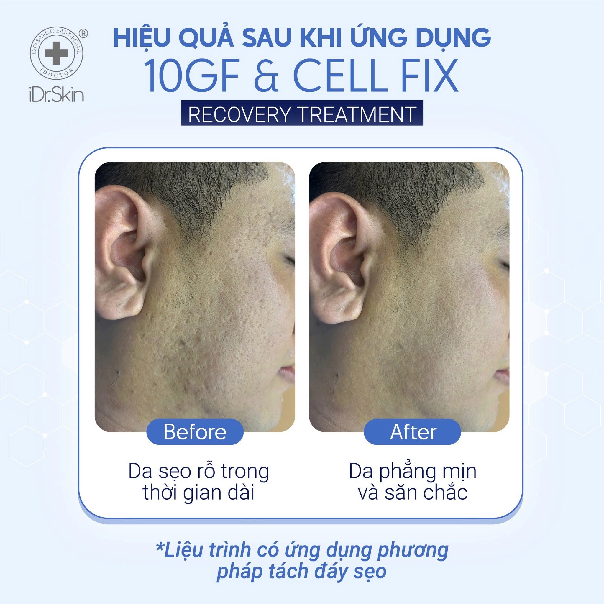 Tinh Chất Tế Bào Gốc Hỗ Trợ Cải Thiện Sẹo Rỗ Idr.Skin 10GF Growth Factor 10ml Chính Hãng