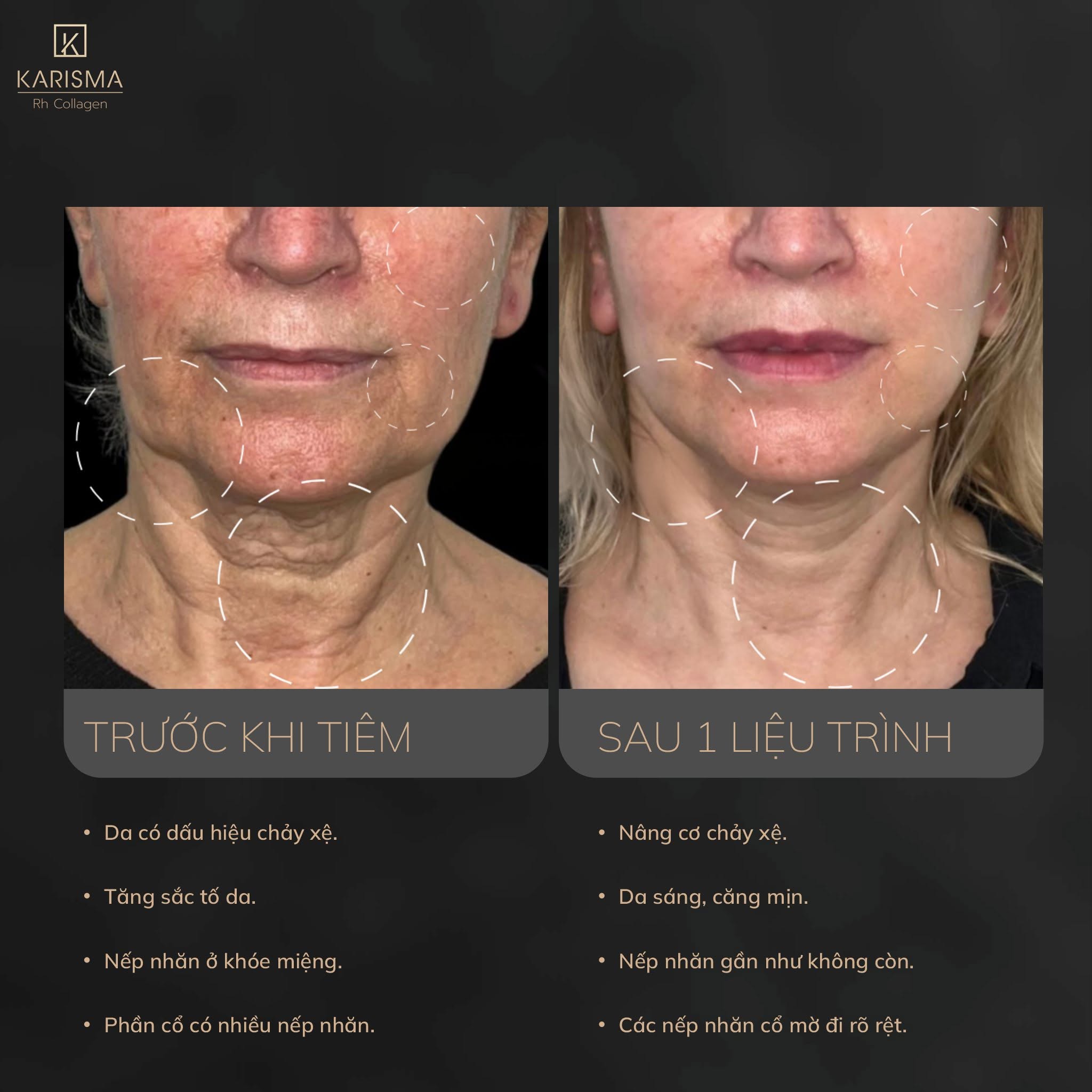 Tinh chất trẻ hóa da KARISMA Rh Collagen
