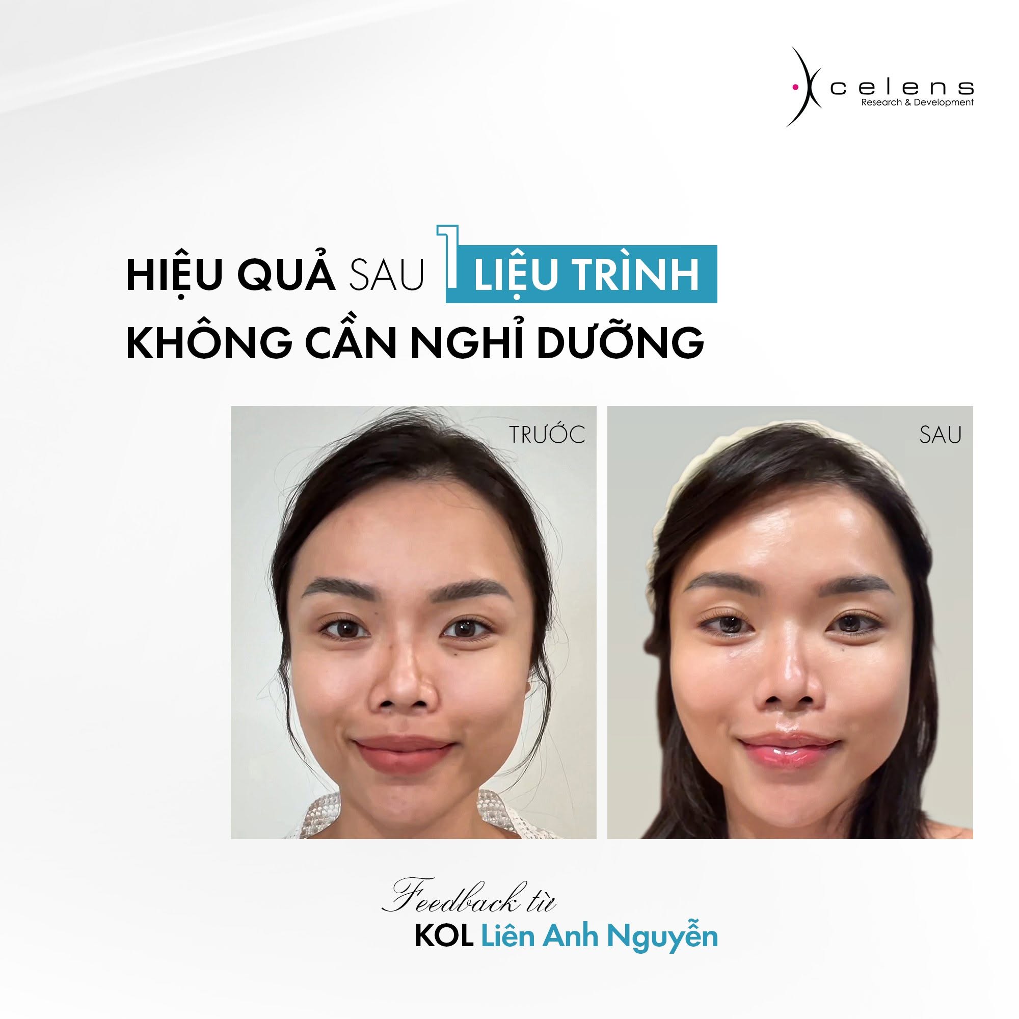 Xcelens Genyal Genyalift – Skin Booster Thu Nhỏ Lỗ Chân Lông, Trẻ Hóa Da