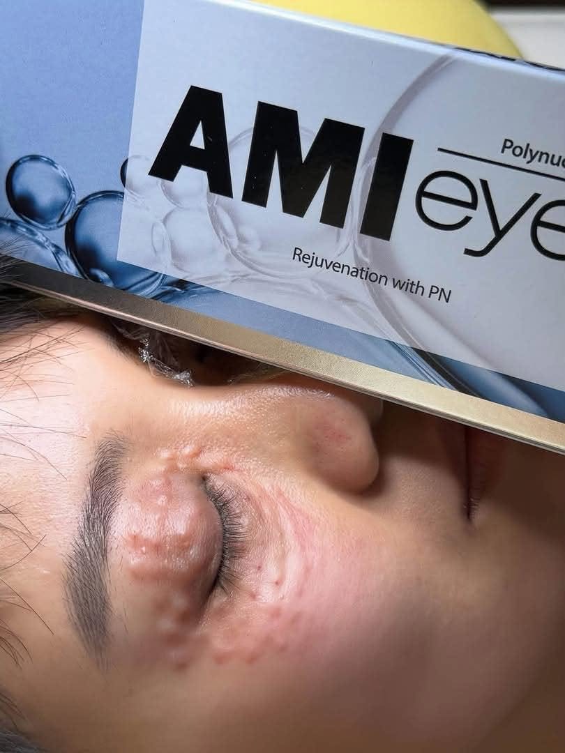 Chất Làm Đầy Ami Eyes Hàn Quốc Hàng Chính Hãng.jpg