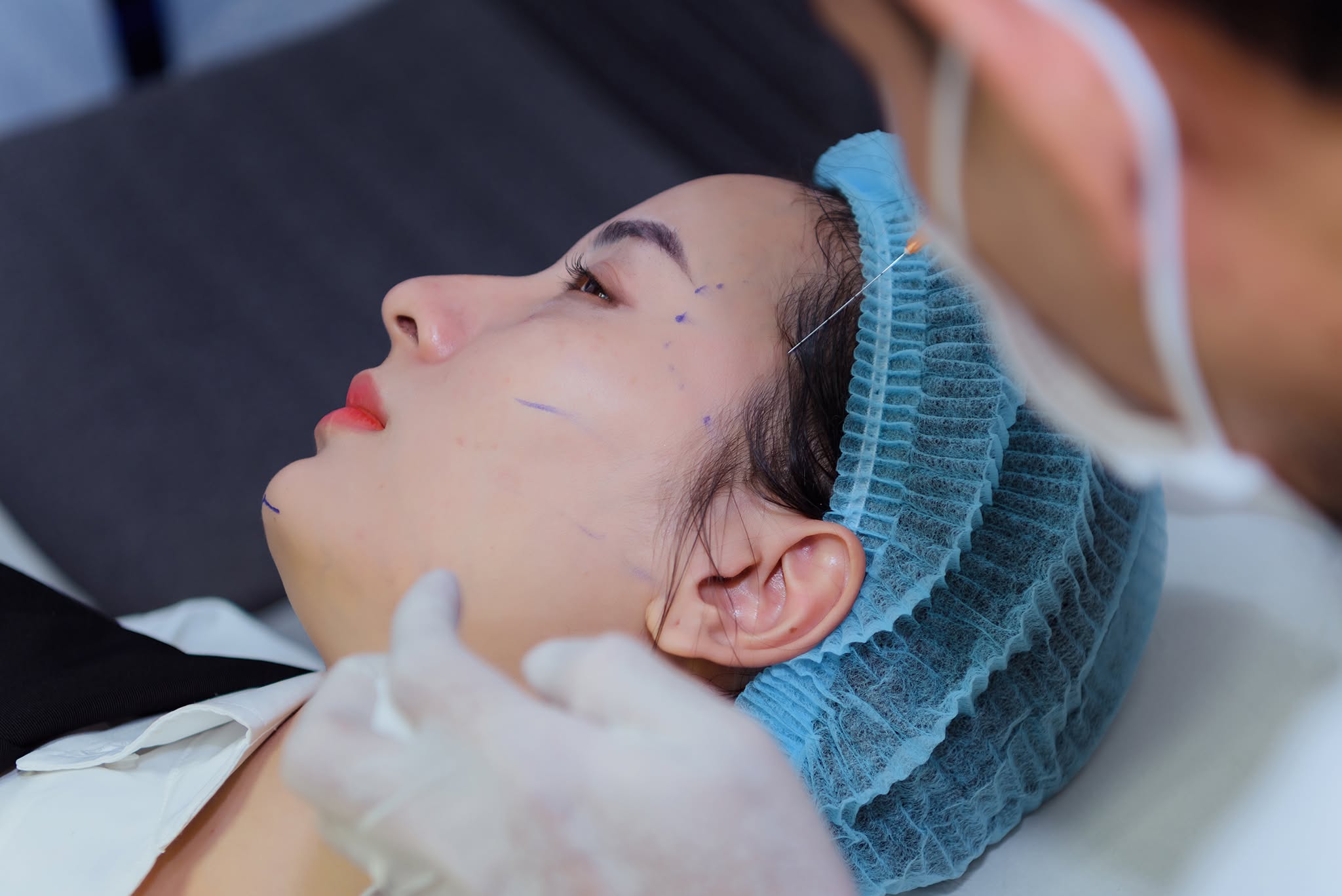 Chất kích thích tăng sinh collagen trẻ hóa da Power Col-tra PLLA Poly-L-Lactic Acid.jpg