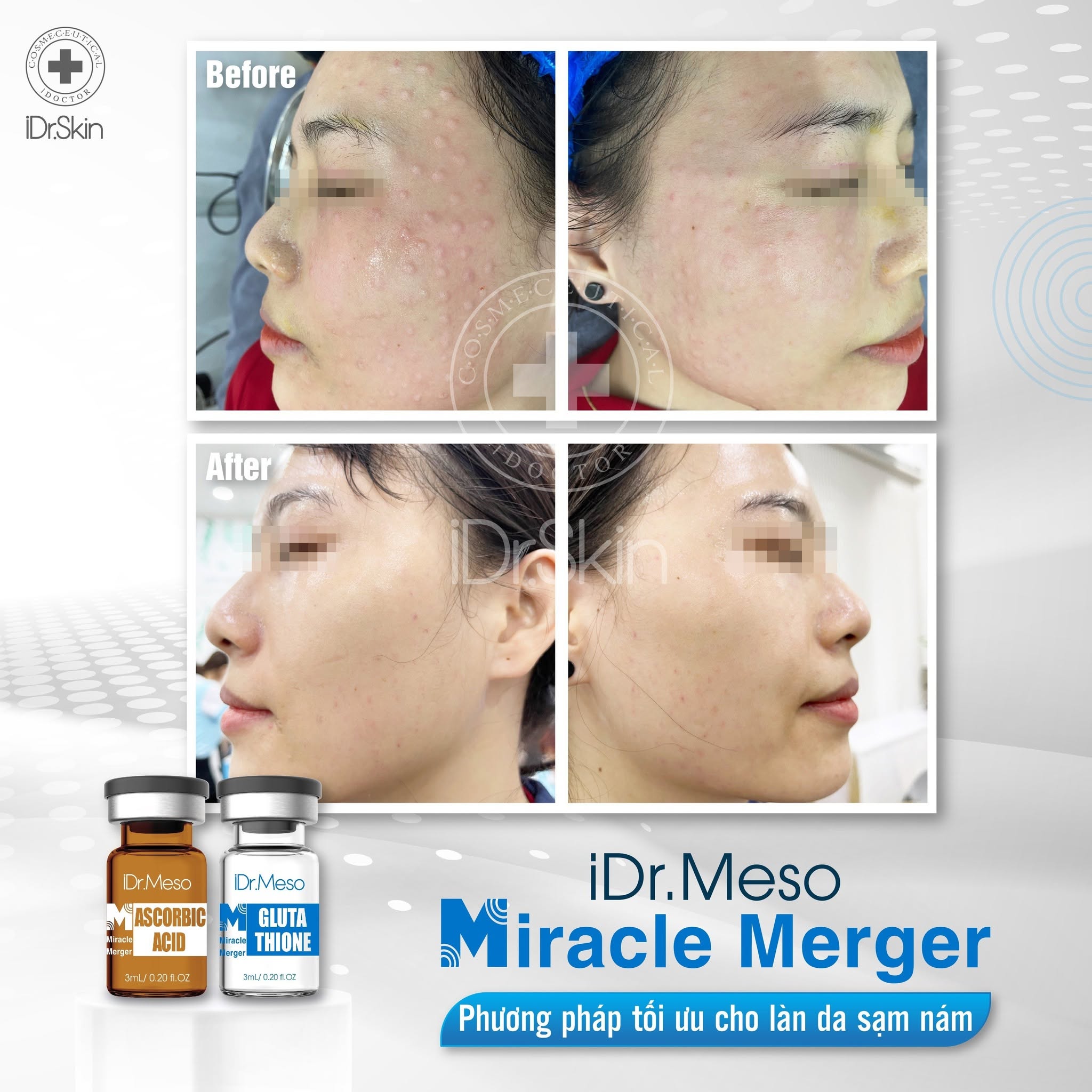 Combo Meso iDr.Skin Vitamin C 20% & Glutathione – Hỗ Trợ Mờ Nám, Dưỡng Sáng Da 11.jpg