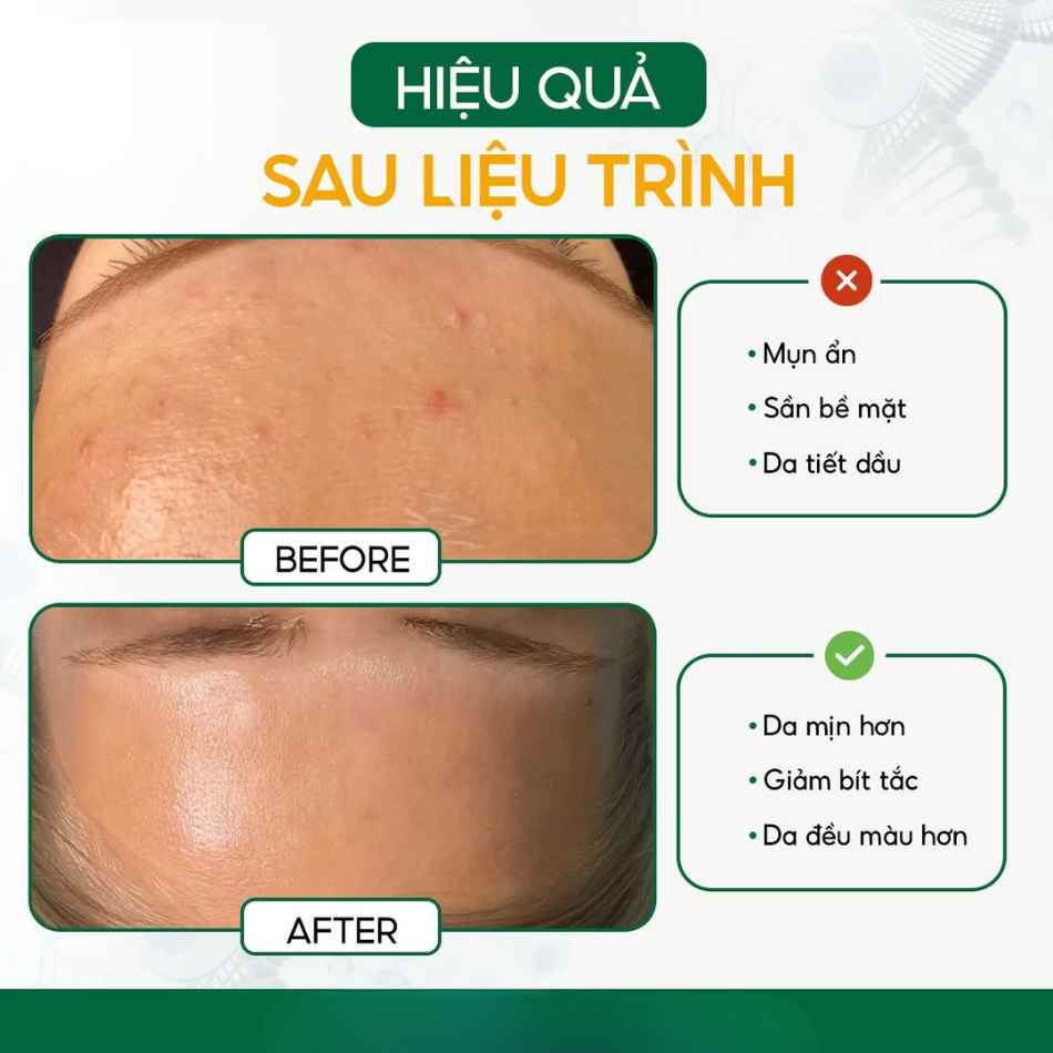 Dung dịch peel hỗ trợ mờ thâm vùng nhạy cảm Innoaesthetics MeLine 01 Intimate (3).jpg
