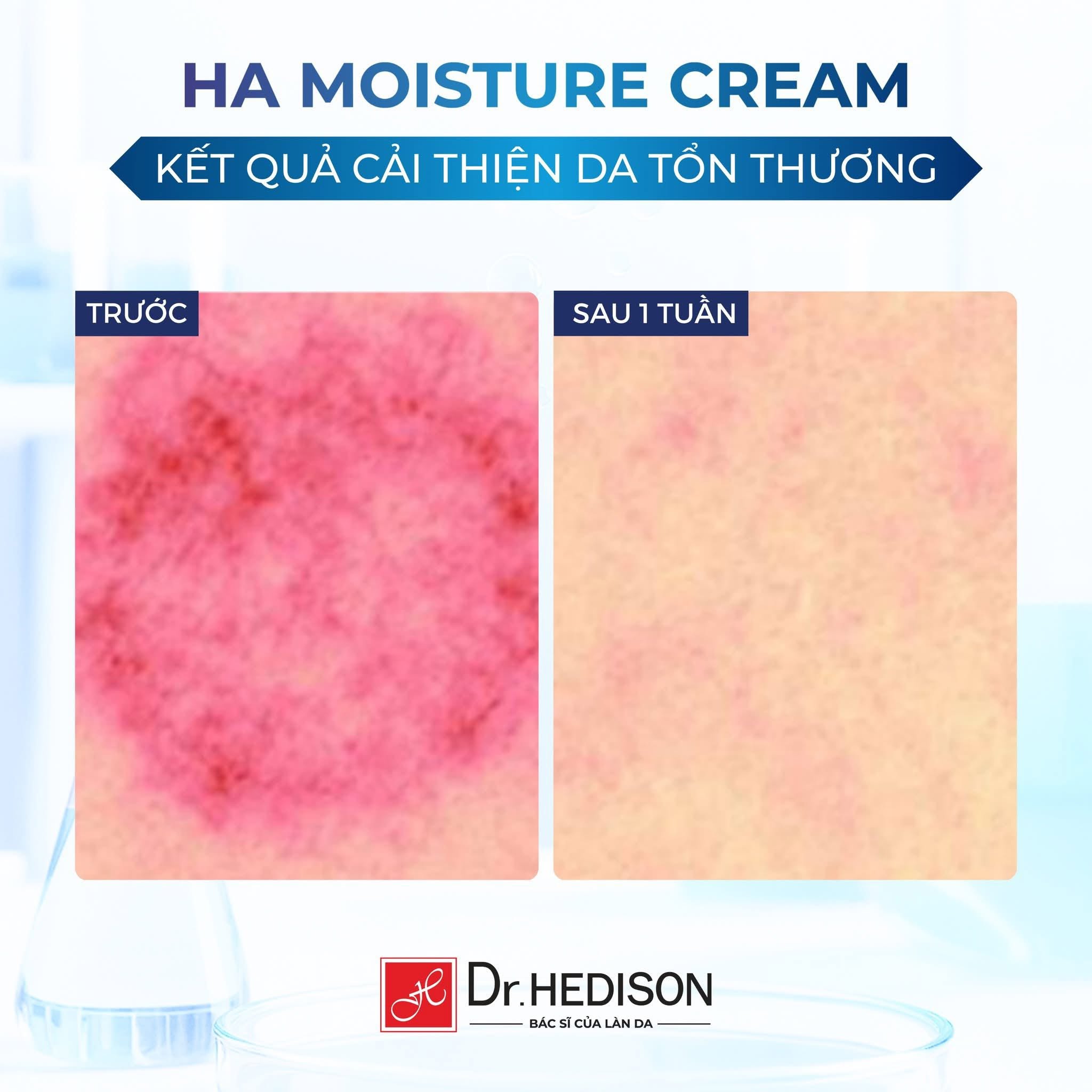 Kem dưỡng ẩm đa tầng, củng cố hàng rào da Dr.HEDISON Hyaluronic Acid Moisture Cream.jpg