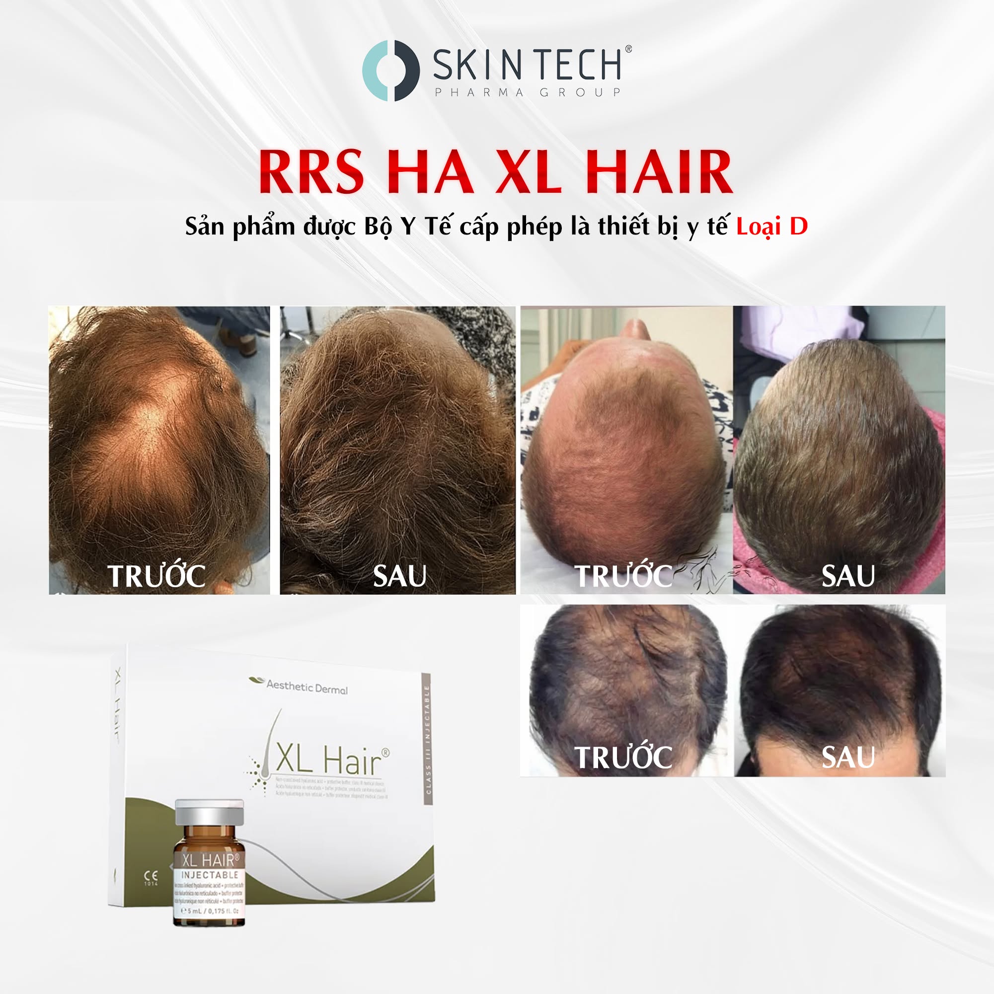 Meso Kích Thích Mọc Tóc SkinTech XL Hair 5ml – Hỗ Trợ Giảm Rụng Và Phục Hồi Nang Tóc 5.jpg