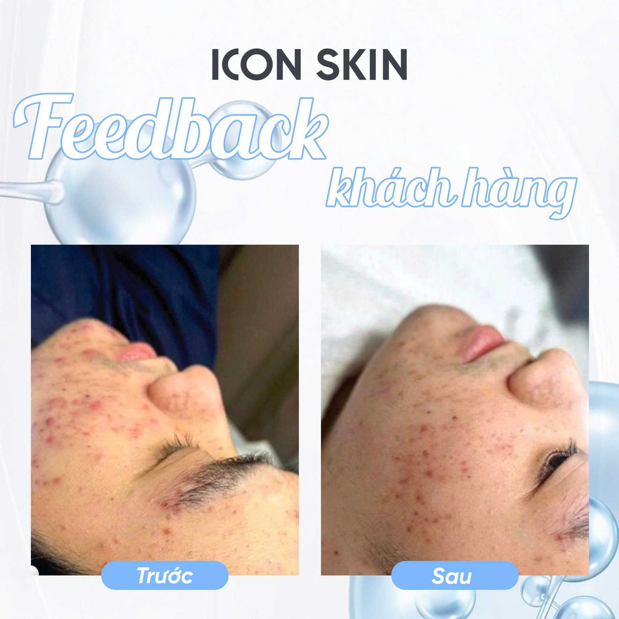 Peel da không bong cho da dầu, da hỗn hợp Icon Skin 18% Anti-Acne Peel System 8.jpg