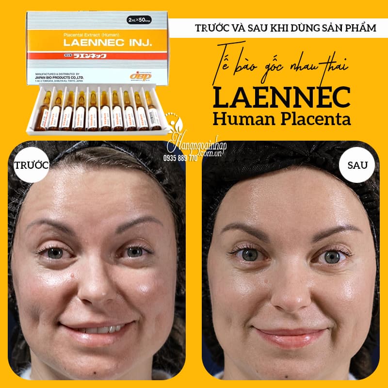 Te-bao-goc-nhau-thai-Laennec-Human-Placenta-cua-Nhat-Ban_Tế bào gốc nhau thai Laennec Human Placenta của Nhật Bản 1.jpg