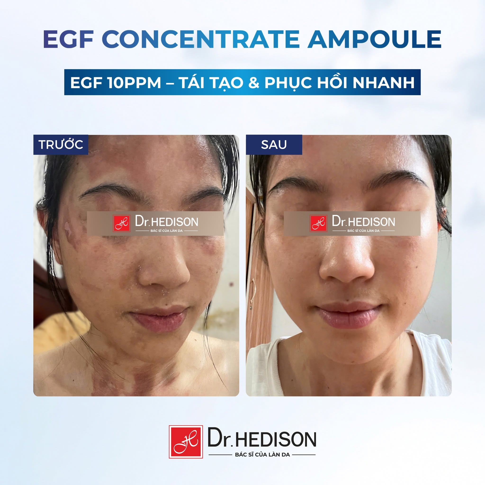 Tinh chất EGF tái tạo da Dr.HEDISON EGF Concentrate Ampoule.jpg