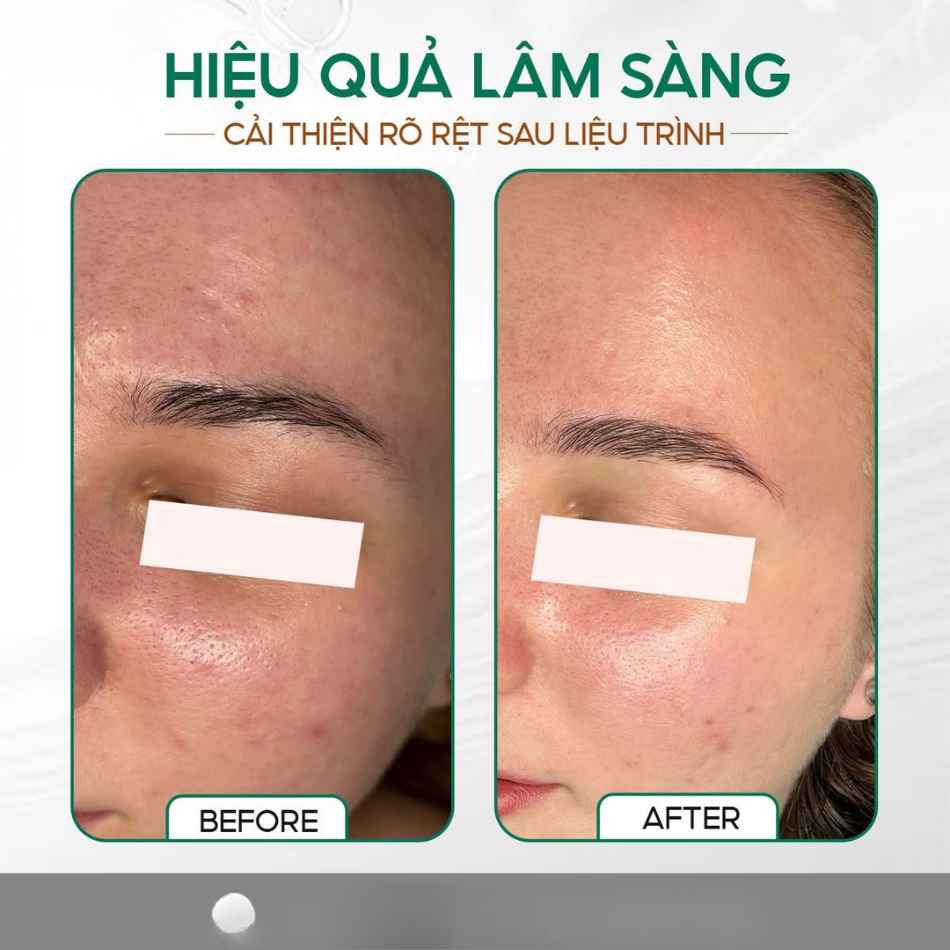Tinh chất meso chăm sóc da dầu mụn Innoaesthetics AKN-ID (8).jpg
