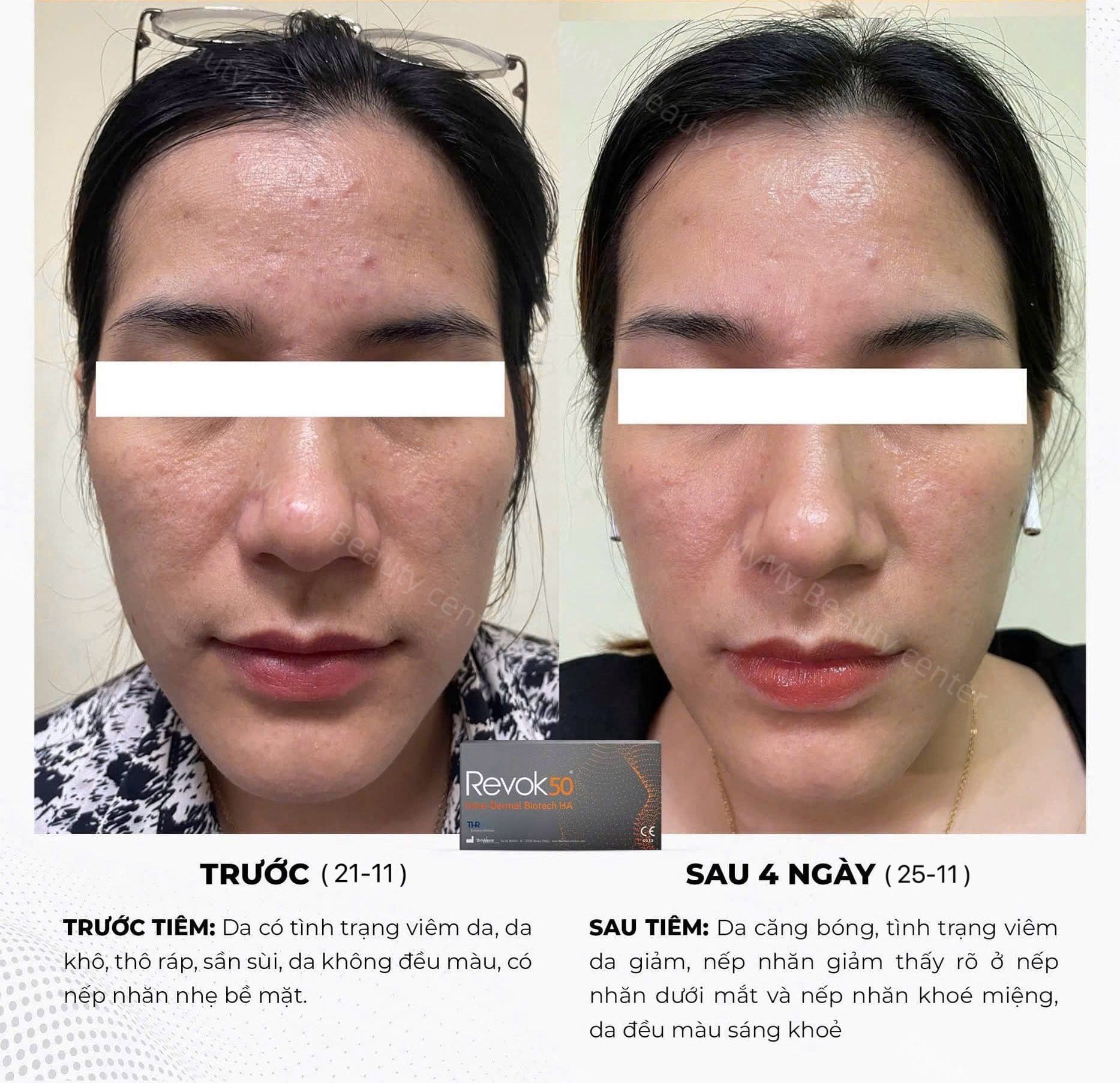 Tinh-chat-nang-co-tre-hoa-toan-dien-REVOK50-hop-2ml_Vì sao REVOK50 được coi là skin booster thế hệ mới (2).jpg