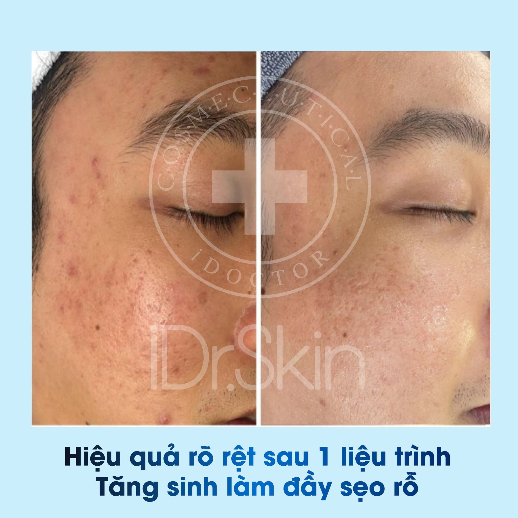 Tinh chất tế bào gốc trị sẹo rỗ Idr.Skin 10GF Growth Factor 10ml 15.jpg