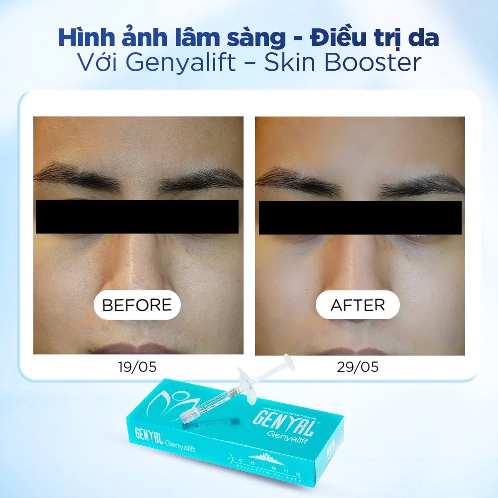 Xcelens Genyal Genyalift – Skin Booster Thu Nhỏ Lỗ Chân Lông, Trẻ Hóa Da 7.jpg