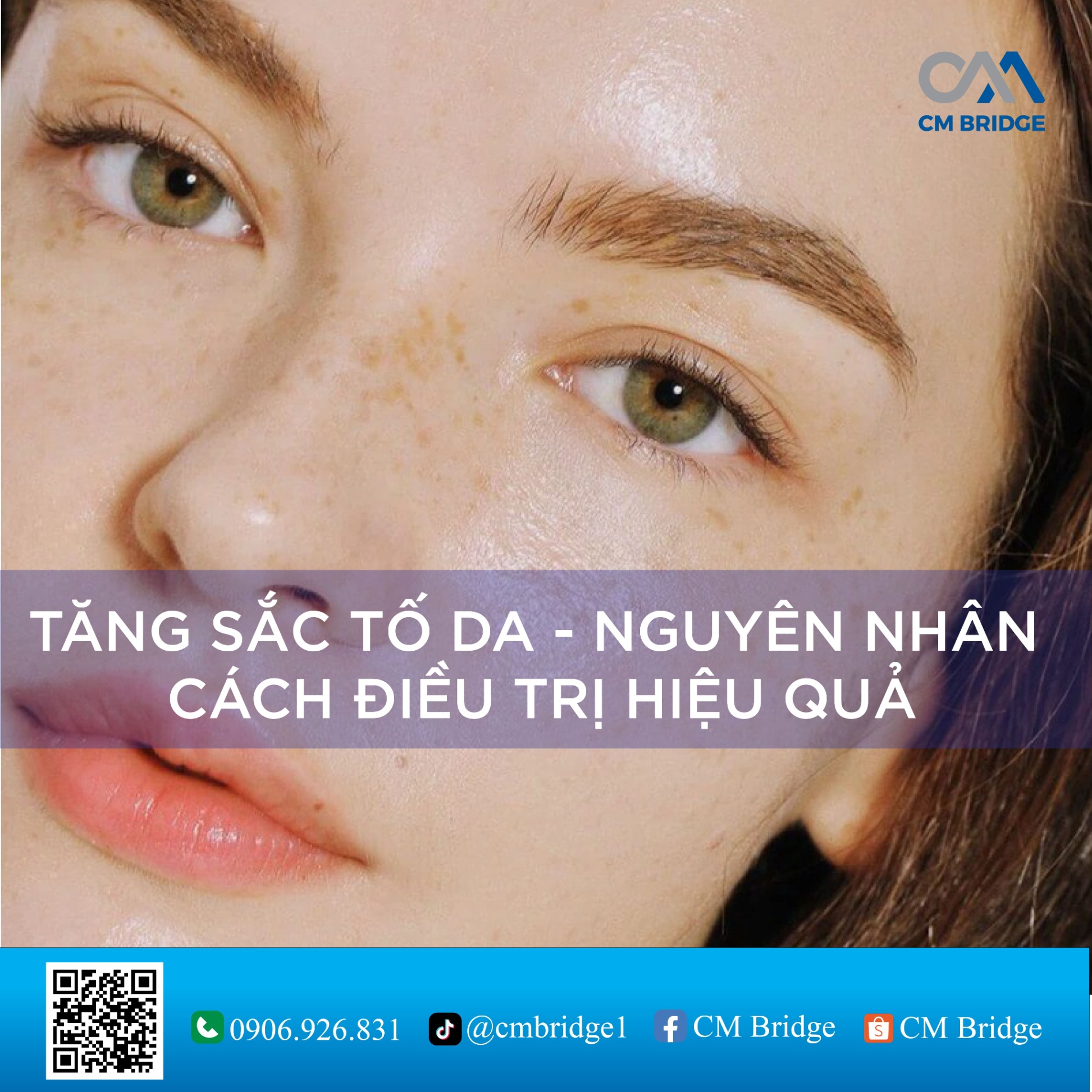 TĂNG SẮC TỐ DA - NGUYÊN NHÂN, CÁCH ĐIỀU TRỊ HIỆU QUẢ