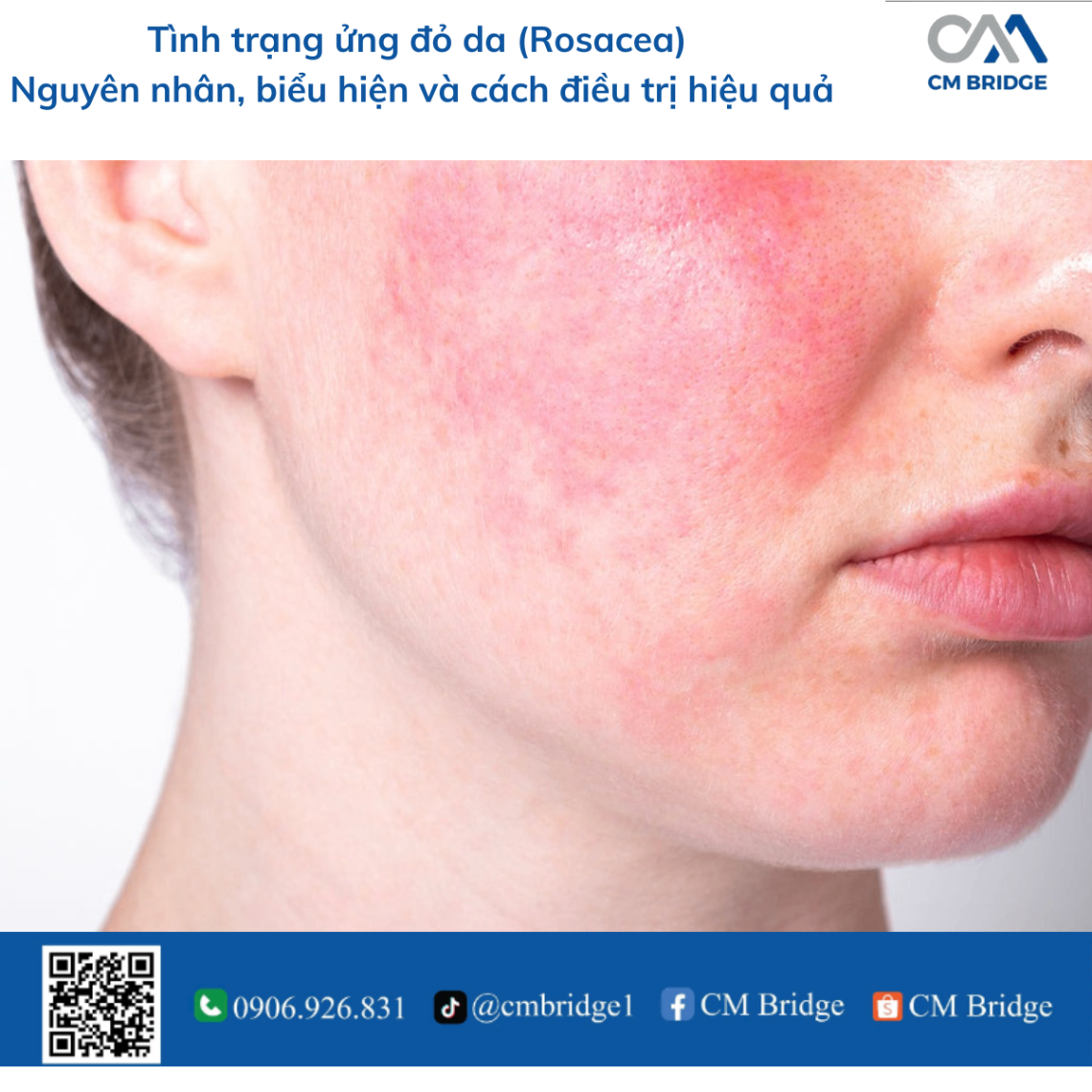 Tình trạng ửng đỏ da (Rosacea). Nguyên nhân, biểu hiện và cách điều trị hiệu quả