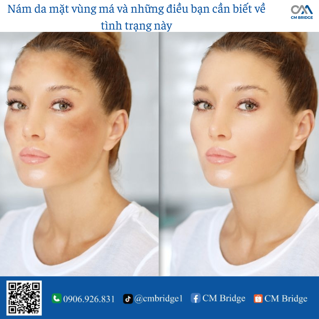 Nám da mặt vùng má và những điều bạn cần biết về tình trạng này