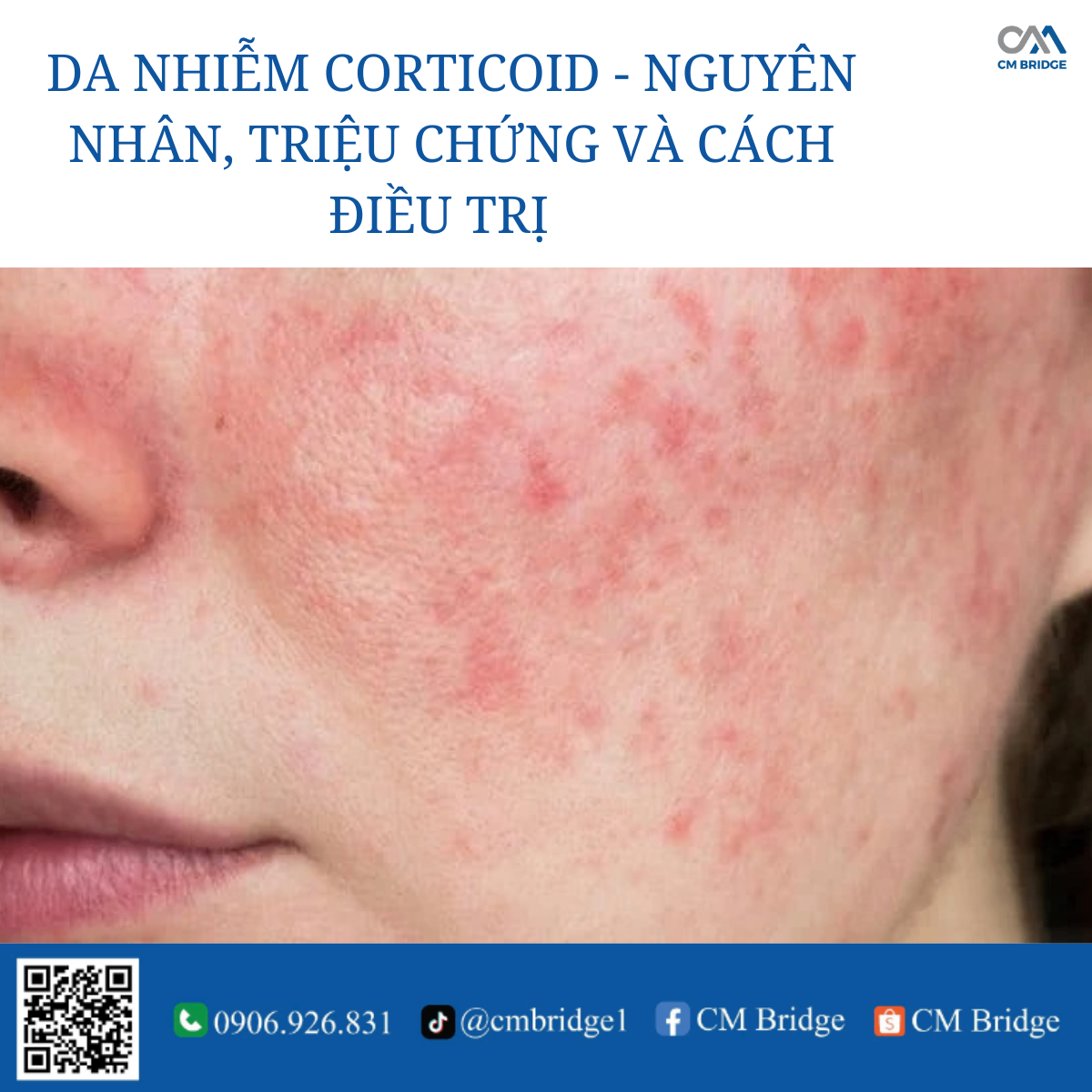 DA NHIỄM CORTICOID - NGUYÊN NHÂN, TRIỆU CHỨNG VÀ CÁCH ĐIỀU TRỊ