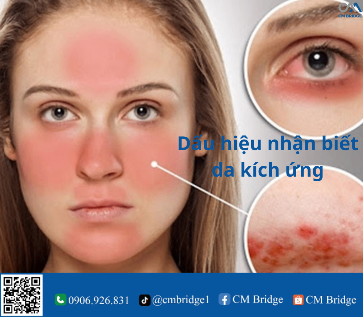 Dấu hiệu nhận biết da kích ứng
