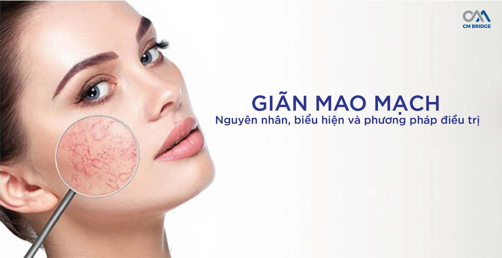 Giãn mao mạch - Nguyên nhân, biểu hiện và phương pháp cải thiện và phục hồi