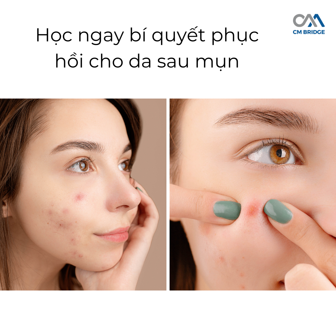 Học ngay bí quyết phục hồi cho da sau mụn