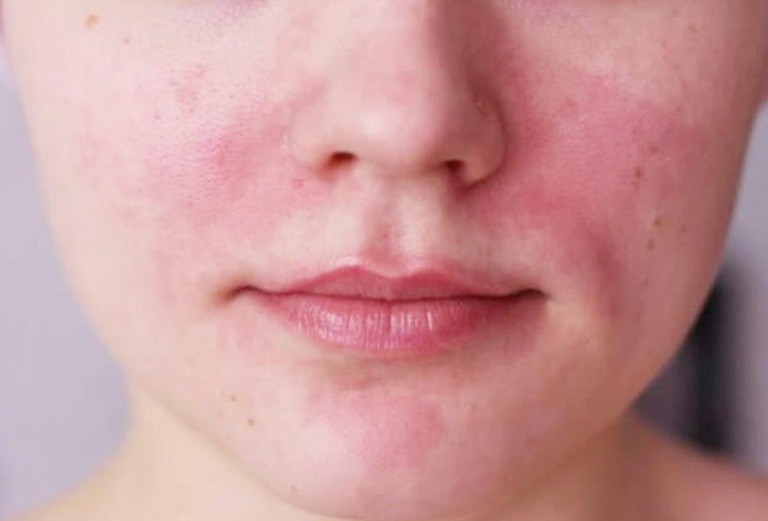 Cách Chữa Trị Da Bị Dị Ứng Thời Tiết Tại Nhà