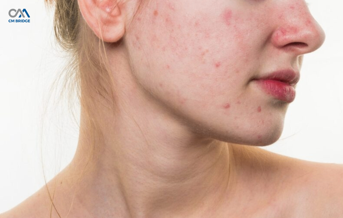 Da Mụn Tẩy Tế Bào Chết Được Không? Lưu Ý Khi Sử Dụng