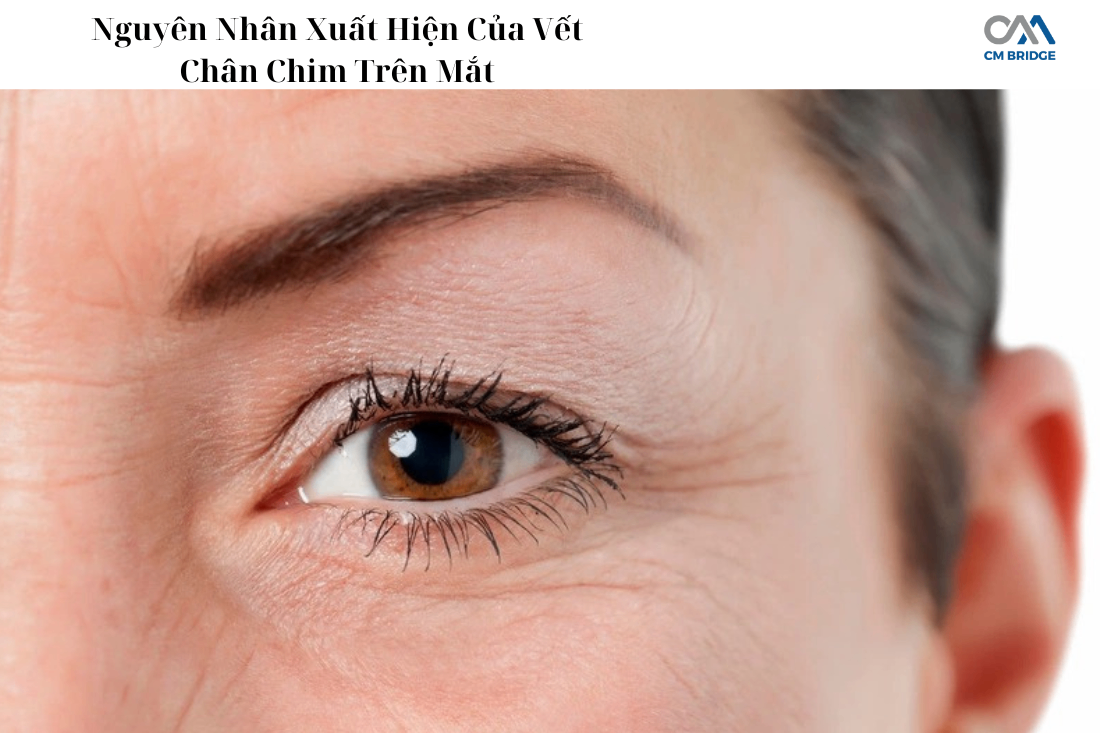 Nguyên Nhân Xuất Hiện Của Vết Chân Chim Trên Mắt
