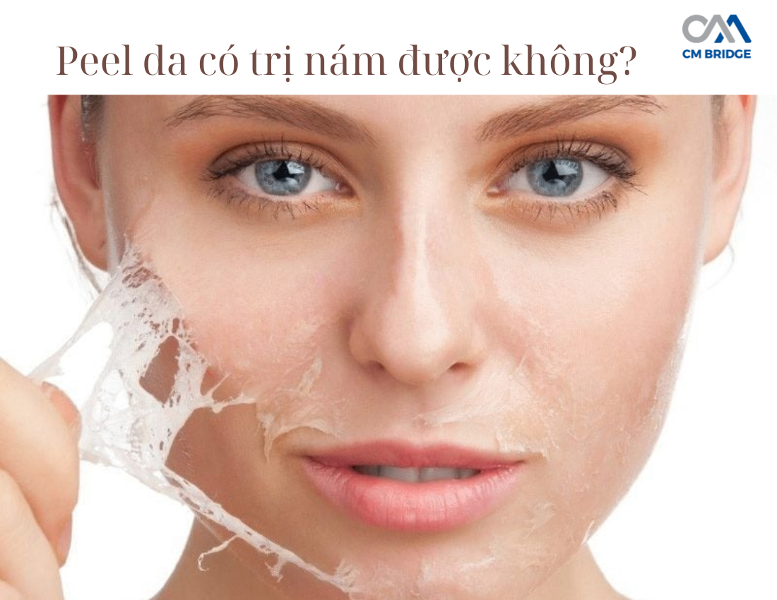 Peel da có trị nám được không?