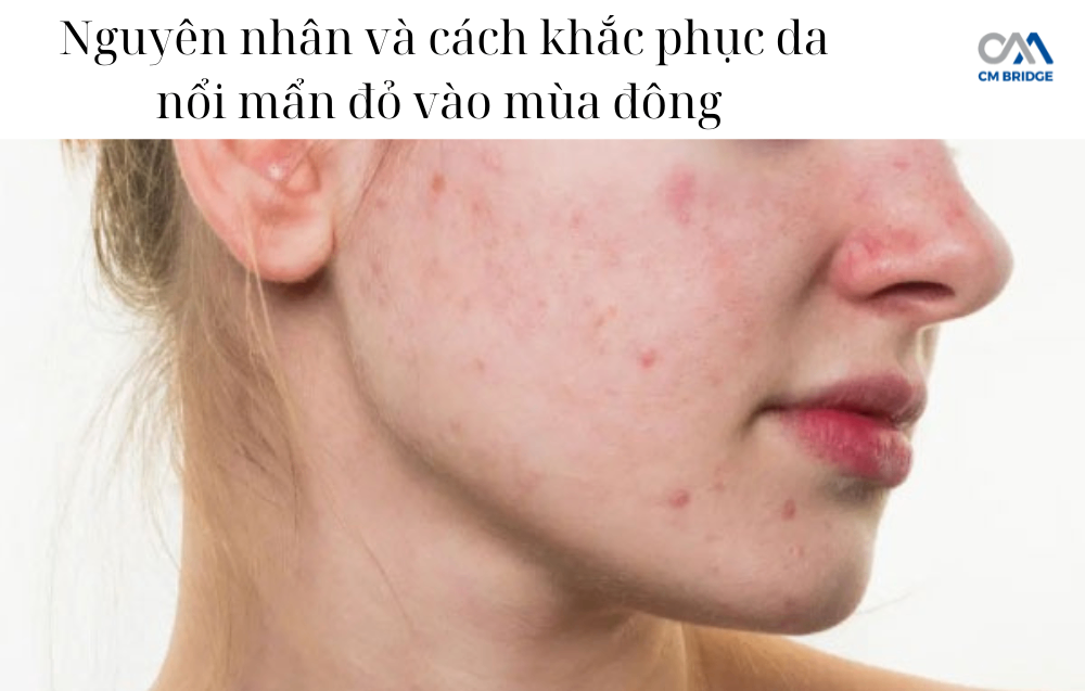 Nguyên nhân và cách khắc phục da nổi mẩn đỏ vào mùa đông