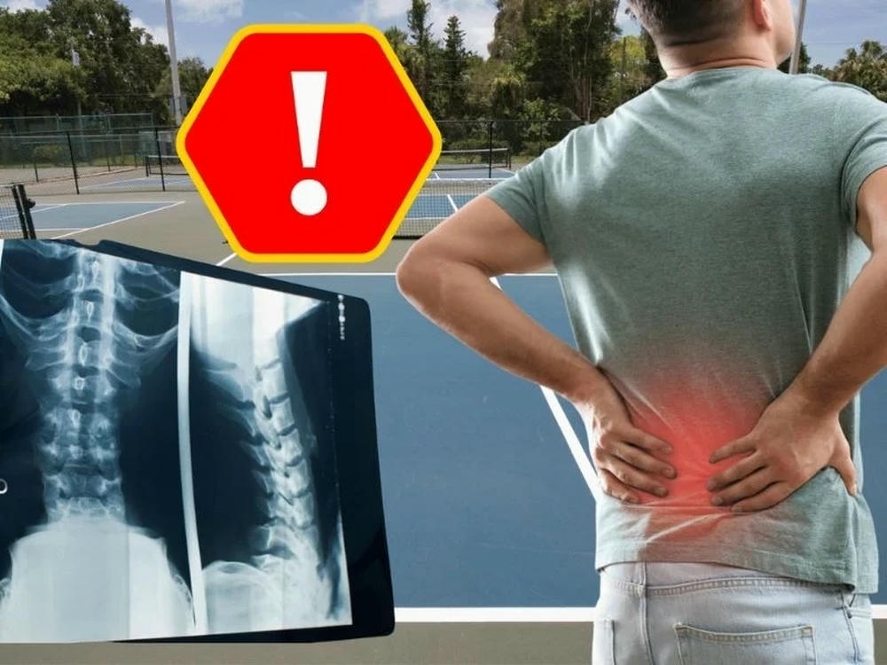 Đau lưng Pickleball do đâu?