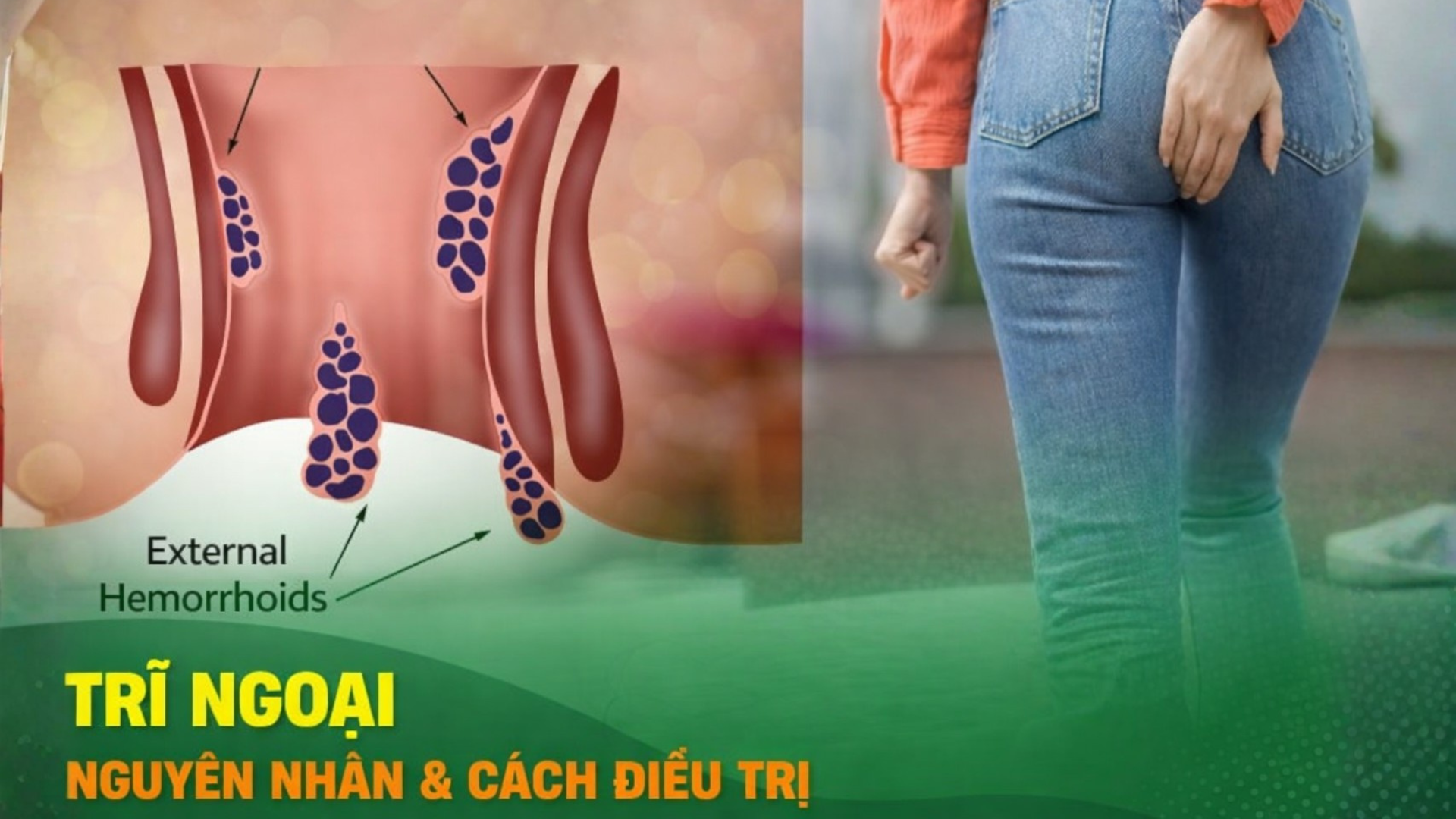 Trĩ ngoại là gì? Nhận biết triệu chứng, hiểu rõ nguyên nhân và cách cải thiện triệu chứng an toàn và  hiệu quả