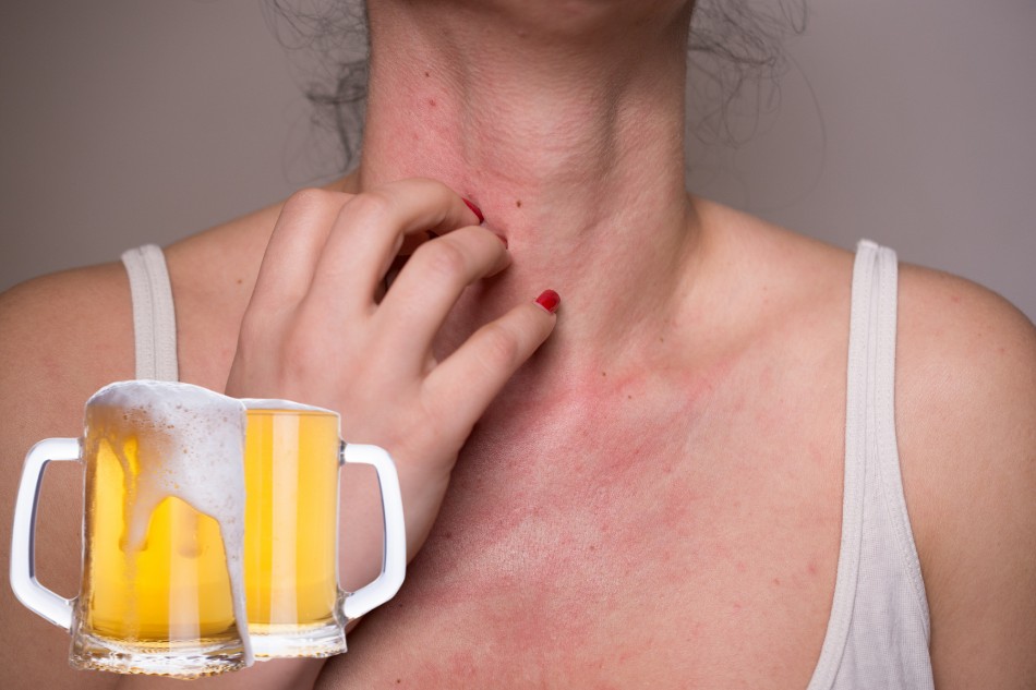 Uống bia bị ngứa, mẩn đỏ nguy hiểm không?
